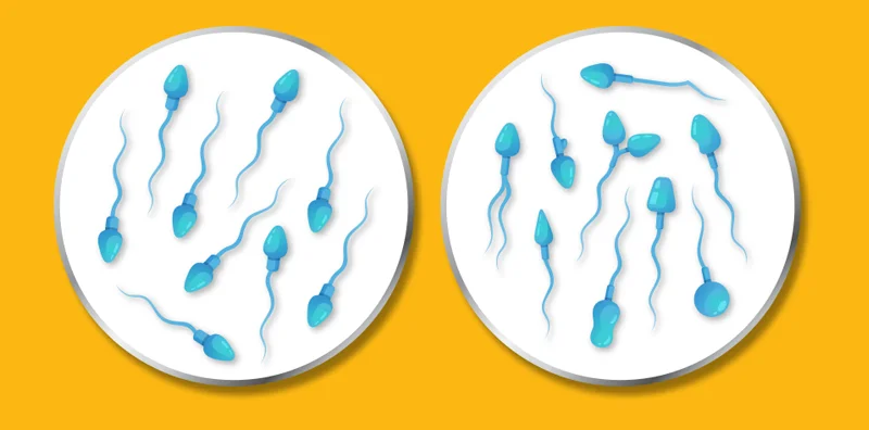 Abnormal Sperm Morphology? Additional Semen Parameters to Check